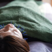 Beauty acupuncture and moxibustion