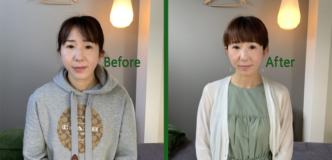 30代女性美容鍼灸Before＆After
