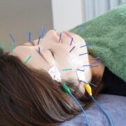 リフトアップ美容鍼灸